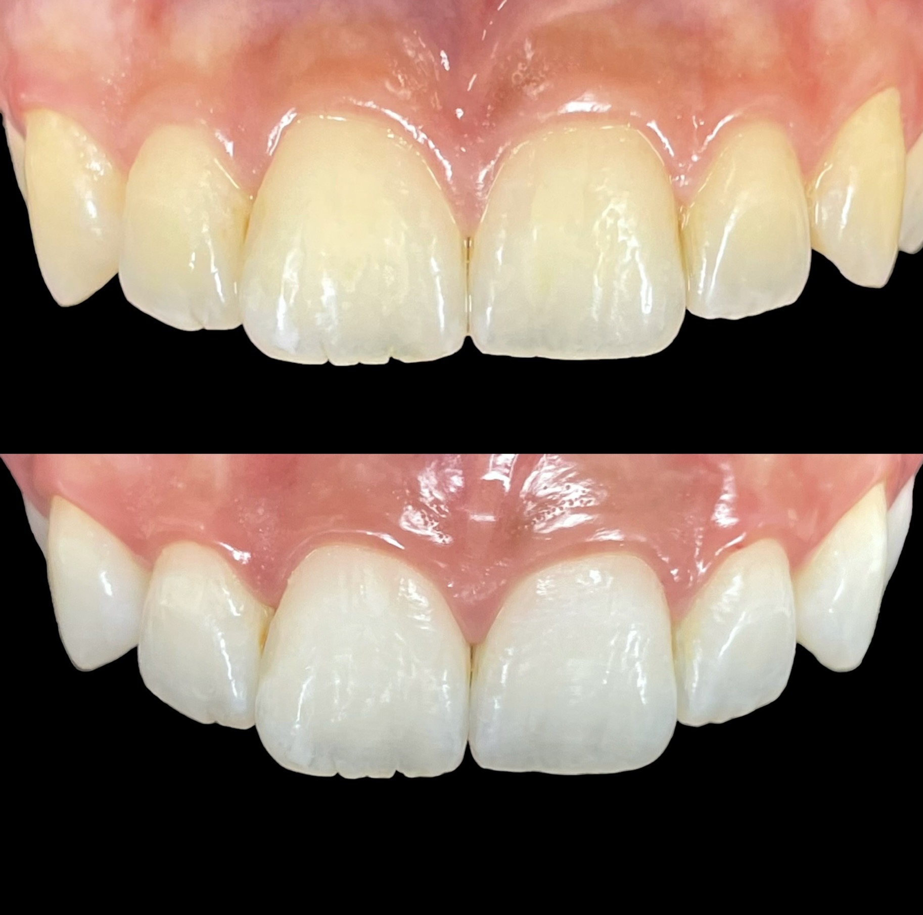 Antes-e-depois-1.-dentes-amarelados-1.jpg